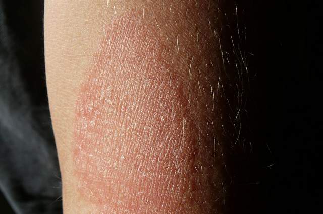 Dermatite atopica sull'avambraccio